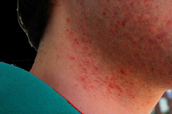 Beard Help: Remedies for Razor Bumps!